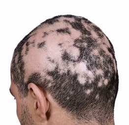 Alopesi (Saçkıran) Çözümleri