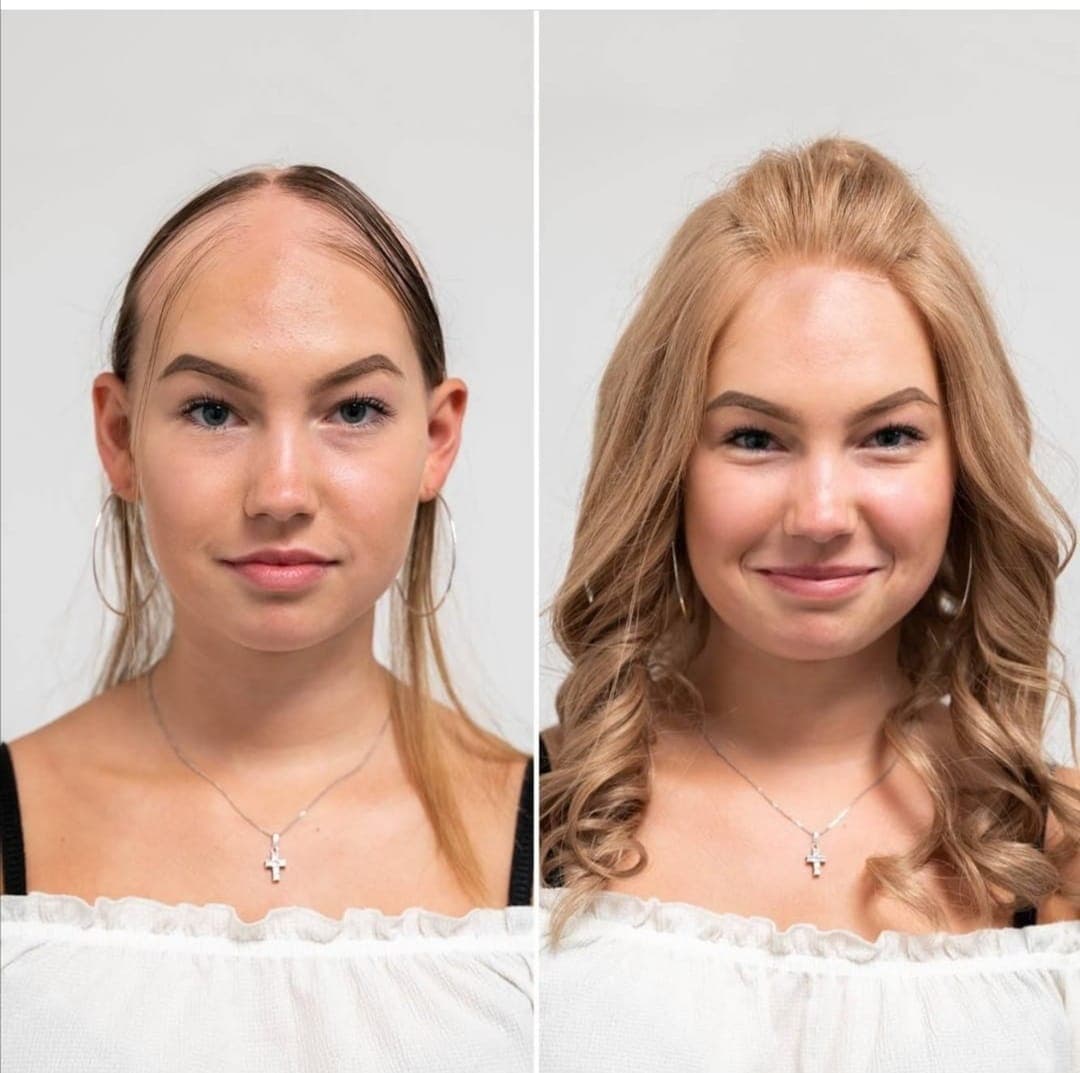 Liken Planopilaris